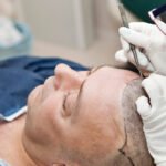 What Is the Cost of FUE Hair Transplants in Melbourne and What Affects It