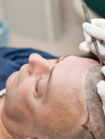 What Is the Cost of FUE Hair Transplants in Melbourne and What Affects It