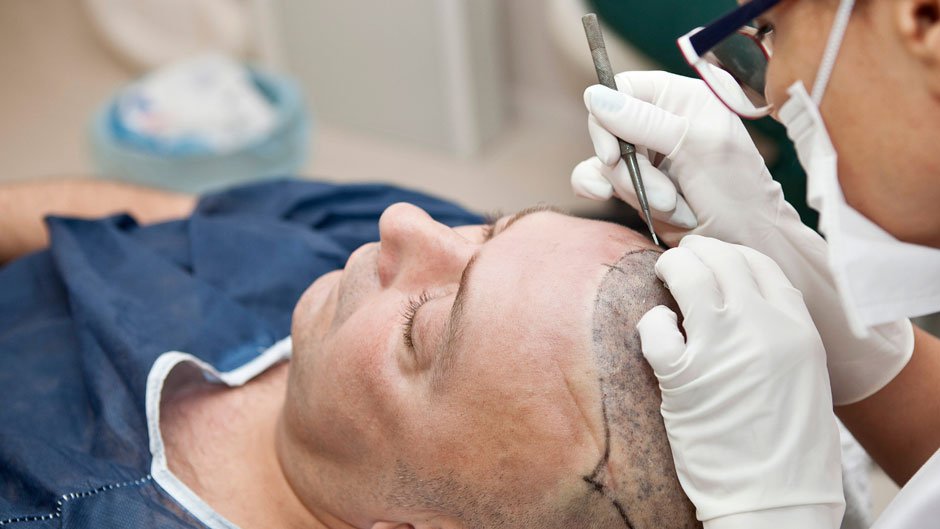 What Is the Cost of FUE Hair Transplants in Melbourne and What Affects It