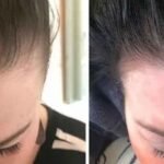 How Scalp Micropigmentation Can Help Those with Alopecia
