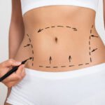 How to Choose the Best Liposculpture Clinic in Sydney