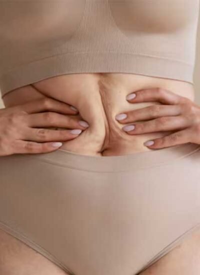 What-to-Know-Before-Getting-a-Tummy-Tuck
