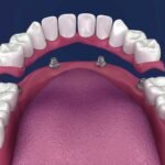 Implant-Supported