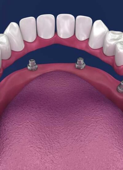 Implant-Supported