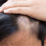 Say Goodbye to Bald Spots with Hair Patches!