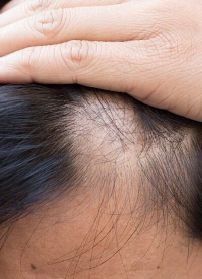 Say Goodbye to Bald Spots with Hair Patches!