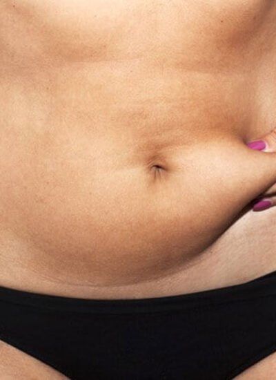 6 Signs a Tummy Tuck Might Be Right for You — According to Experts