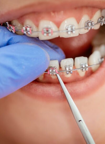 Braces with Crowns or Bridges: Is Orthodontic Treatment Still Possible?