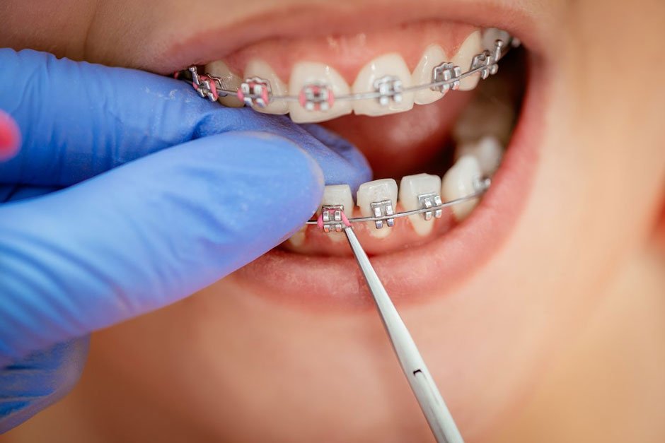 Braces with Crowns or Bridges: Is Orthodontic Treatment Still Possible?