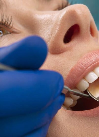 Dental Fillings