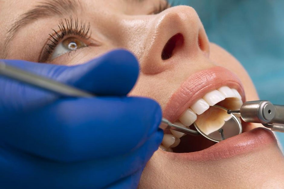 Dental Fillings