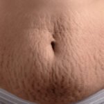 From Stretch Marks to Strength