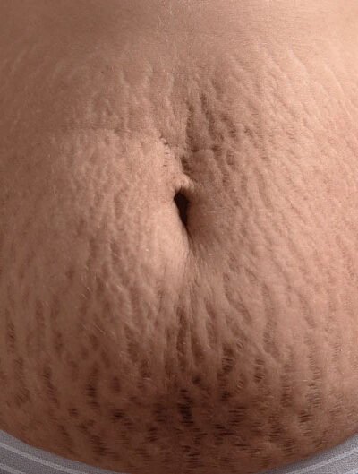From Stretch Marks to Strength