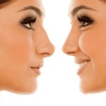 Rhinoplasty Results: When to Expect Your Final Transformation