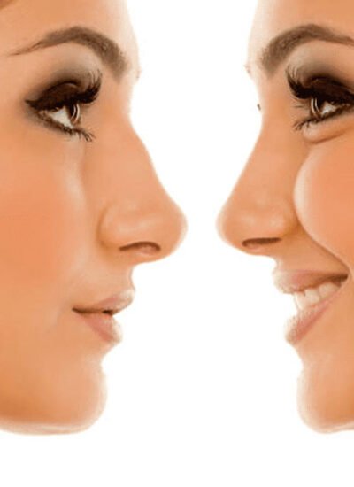 Rhinoplasty Results: When to Expect Your Final Transformation