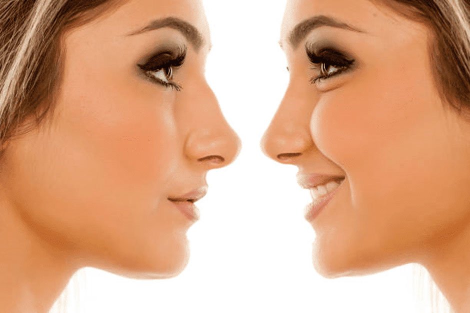 Rhinoplasty Results: When to Expect Your Final Transformation