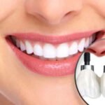 You’ll Be Smiling Again With Dental Implants