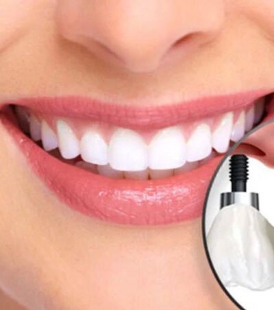 You’ll Be Smiling Again With Dental Implants