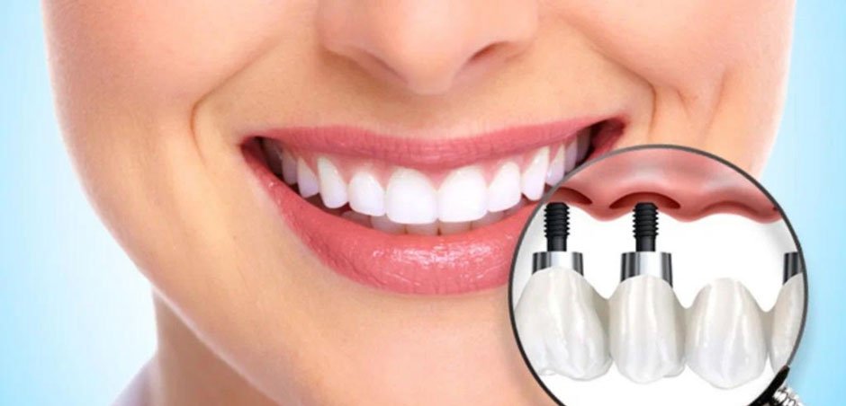 You’ll Be Smiling Again With Dental Implants