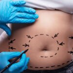 5 Essential Facts to Know Before Undergoing a Tummy Tuck