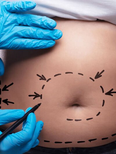 5 Essential Facts to Know Before Undergoing a Tummy Tuck