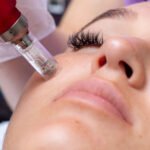 What Popular Myths Revolve Around Microneedling