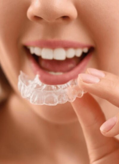 The Best Nighttime Mouth Guards for Teeth Clenching and Grinding