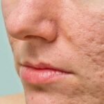 Achieving Skin Confidence