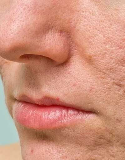 Achieving Skin Confidence