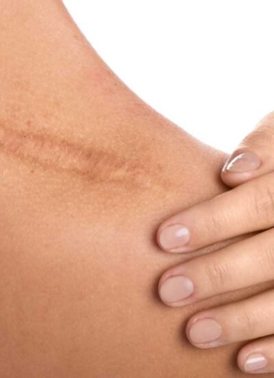 The Path to Flawless Texture Through Advanced Scar Procedures