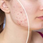 Transformative Acne Treatments for Smooth