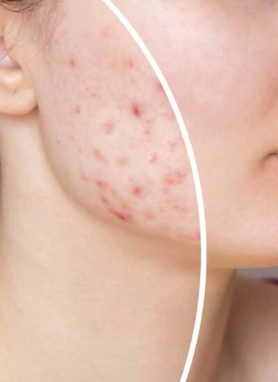 Transformative Acne Treatments for Smooth
