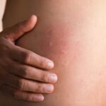 5 Ways an Allergy Specialist Helps You Get Lasting Relief