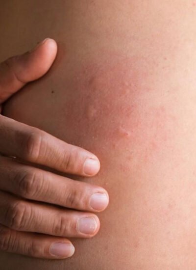 5 Ways an Allergy Specialist Helps You Get Lasting Relief