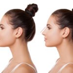 Can a Nose Job Look Natural or Will It Change Your Face Too Much