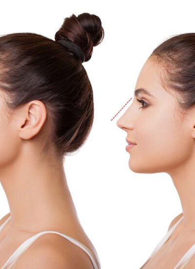 Can a Nose Job Look Natural or Will It Change Your Face Too Much