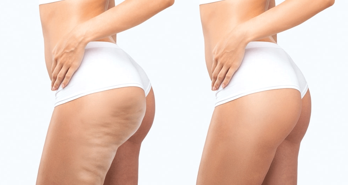 Effective Approaches for Minimizing the Appearance of Cellulite