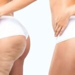 Effective-Approaches-for-Minimizing-the-Appearance-of-Cellulite