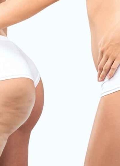 Effective-Approaches-for-Minimizing-the-Appearance-of-Cellulite