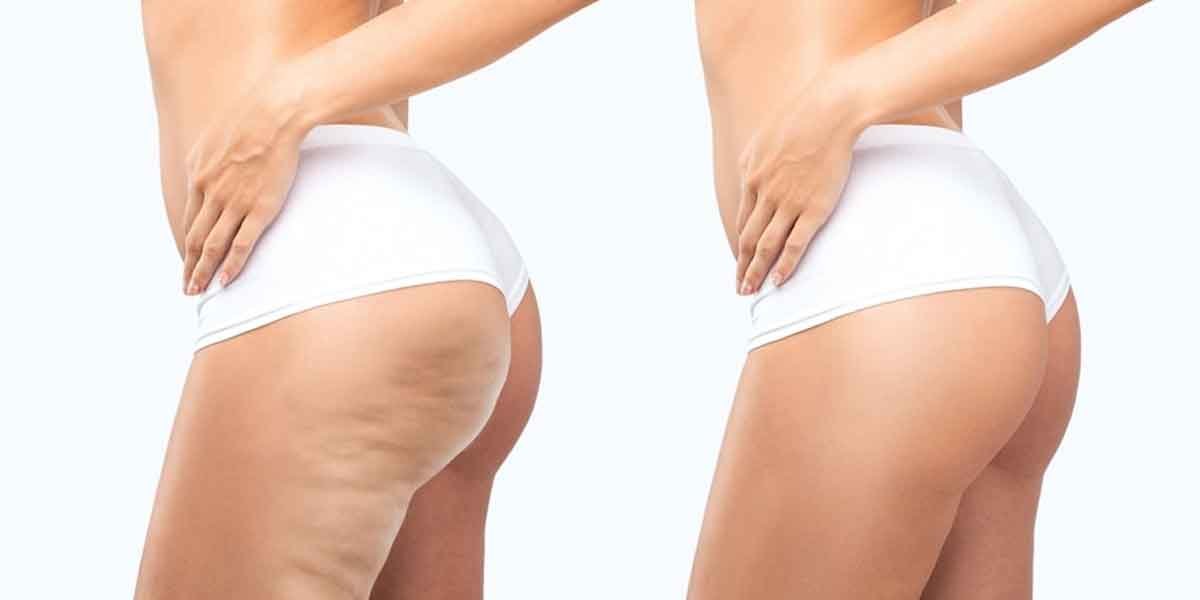 Effective-Approaches-for-Minimizing-the-Appearance-of-Cellulite