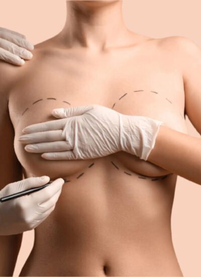 What to Know Before Getting Breast Augmentation Surgery